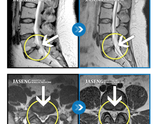 MRI before after, мрт до и после, безоперационный метод лечения грыжи, больница часэн, лечение позвонковой грыжи, мрт грыжи, грыжа в пояснице, грыжа позвоночника, грыжа, грыжа не приговор