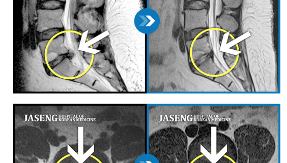 MRI before after, мрт до и после, безоперационный метод лечения грыжи, больница часэн, лечение позвонковой грыжи, мрт грыжи, грыжа в пояснице, грыжа позвоночника, грыжа, грыжа не приговор