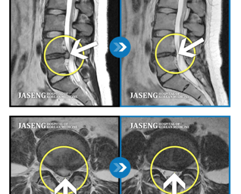MRI before after, мрт до и после, безоперационный метод лечения грыжи, больница часэн, лечение позвонковой грыжи, мрт грыжи, грыжа в пояснице, грыжа позвоночника, грыжа, грыжа не приговор