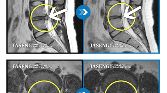 MRI before after, мрт до и после, безоперационный метод лечения грыжи, больница часэн, лечение позвонковой грыжи, мрт грыжи, грыжа в пояснице, грыжа позвоночника, грыжа, грыжа не приговор