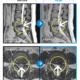 MRI before after, мрт до и после, безоперационный метод лечения грыжи, больница часэн, лечение позвонковой грыжи, мрт грыжи, грыжа в пояснице, грыжа позвоночника, грыжа, грыжа не приговор