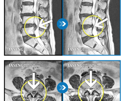 MRI before after, мрт до и после, безоперационный метод лечения грыжи, больница часэн, лечение позвонковой грыжи, мрт грыжи, грыжа в пояснице, грыжа позвоночника, грыжа, грыжа не приговор