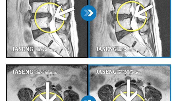 MRI before after, мрт до и после, безоперационный метод лечения грыжи, больница часэн, лечение позвонковой грыжи, мрт грыжи, грыжа в пояснице, грыжа позвоночника, грыжа, грыжа не приговор