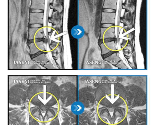 MRI before after, мрт до и после, безоперационный метод лечения грыжи, больница часэн, лечение позвонковой грыжи, мрт грыжи, грыжа в пояснице, грыжа позвоночника, грыжа, грыжа не приговор, секвестрация грыжи