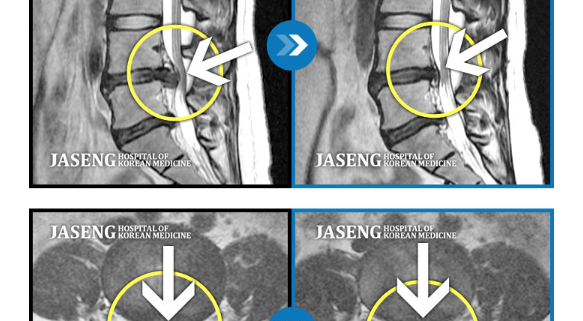 MRI before after, мрт до и после, безоперационный метод лечения грыжи, больница часэн, лечение позвонковой грыжи, мрт грыжи, грыжа в пояснице, грыжа позвоночника, грыжа, грыжа не приговор, секвестрация грыжи