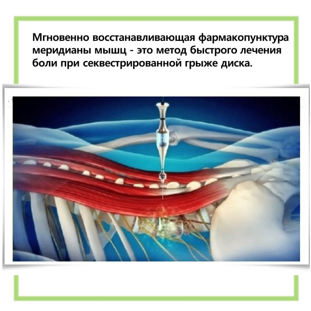 #больвспине #безоперационныйметодлечениягрыжи #больницачасэн #клиникачасэн #лечениегрыжи #лечениепозвоночника #лечениевкорее #секвестрированнаягрыжа