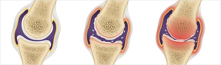 arthritis
