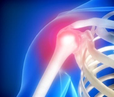 bursitis