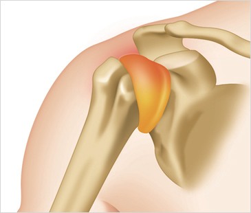bursitis