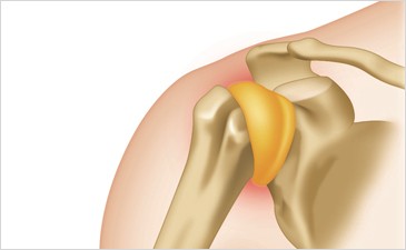 frozenshoulder