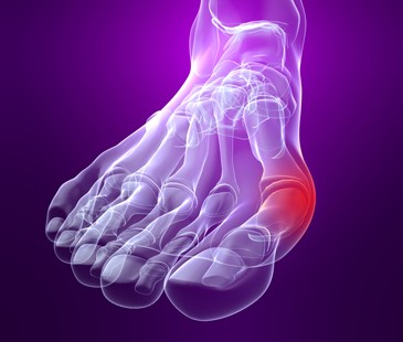 halluxvalgus