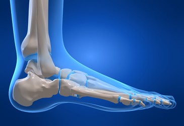 plantarfasciitis