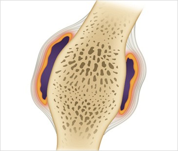 rheumatoid
