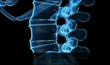 spondylolisthesis