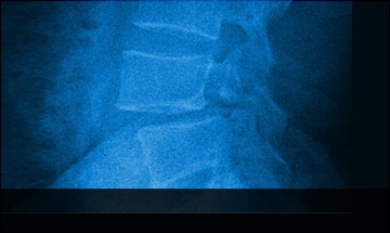 spondylolisthesis
