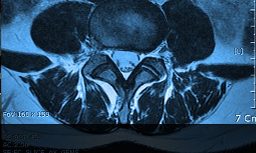 stenosis