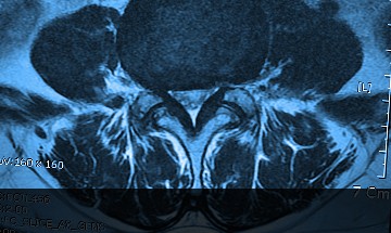 stenosis