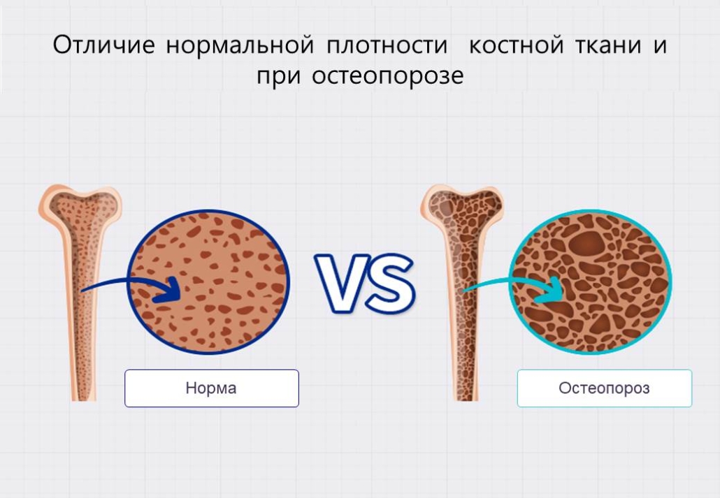 Кости - самое твердое образование человеческого организма, которые поддерживают наше тело. Однако, кости не видны снаружи невооруженному глазу, поэтому мы не заостряем на них особенного внимания. На самом деле, кости в нашем организме постоянно формируются, удаляются и разрушаются – ведут постоянный активный процесс. Но если в этом процессе кости по каким-либо разным причинам не могут быть сформированы должным образом, возникает заболевание «остеопороз», который снижает качество костной ткани. Проще говоря, остеопороз - это состояние, при котором ослаблена прочность наших костей. Для нас привычно видеть изображение поперечного среза кости, где показано много маленьких дырочек. Если более точно и правильней говорить, не дырочки появляются в костной ткани, а поскольку плотность костной ткани снижается от нормальных величин, кости становится все более тонкими и рыхлыми. Когда прочность костей снижается, даже легкое внешнее повреждение может легко вызвать перелом, при котором внутренняя костная ткань крошится на маленькие кусочки. Вот почему вы должны подозревать наличие остеопороза в организме, когда вдруг заметно снижается рост.