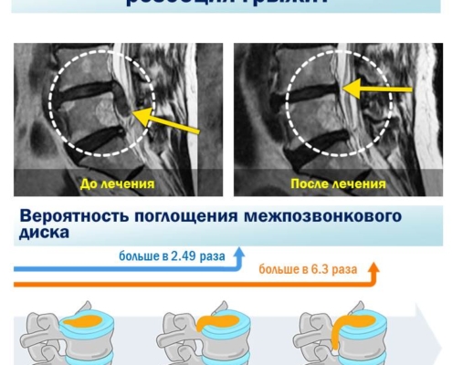 Результаты клинического исследования показали, что после лечения секвестрированная грыжа рассосалась. В Научно-исследовательском Институте Часэн по лечению позвоночника в результате последующего наблюдения за 505 пациентами с заболеванием меж позвонковая грыжа, которые получали комплексное лечение травяными препаратами в среднем в течение 4 лет и 3 месяцев, результат показал чем больше грыжа, и больше секвестрация грыжи, тем лучше она абсорбировалась.Цель: с февраля 2012 года по декабрь 2015 года в главном центре Каннам и филиалах (Кванхвамун, Новон, Мокдонг, Джамсил, Пучхон, Бунданг, Сувон, Ансан, Ильсан, Пхенчон, Кванджу, Тэгу, Тэджон, Сомён, Ульсан) 505 пациентов с диагнозом грыжа поясничного диска получили комплексное лечение травяными препаратами.Метод: после комплексного лечения корейской медицины, включая мануальную терапию — Чуна, степень абсорбции диска измерялась с помощью 3D-анализа МРТ и наблюдалась в среднем в течение 4 лет.Научное учреждение: Объединенный научно-исследовательский институт по лечению позвоночника Часэн.Опубликовано в международном академическом журнале уровня SCI (E) «Evidence-based Complementary and Alternative Medicine Journal (IF 1.93)».Легко подумать, что если диск лопнул, его можно удалить только хирургическим путем. Однако в ходе этого исследования было обнаружено, что даже нехирургическое лечение травяными препаратами может в достаточной степени поглотить вытекший диск. В результате наблюдения за степенью абсорбции диска в течение 4 лет в среднем 45 дней аутогенного лечения у большинства из 505 пациентов у 486 пациентов грыжа рассосалась. Среди них секвестрированная грыжа поглощалась лучше, чем выступающая протрузия. Поглощение диска также было выше в секвестрированной грыже, чем в обычной грыже . Пациенты с более чем 50% абсорбции диска с секвестрированной грыжи (48%) были в 3,7 раза выше, чем с выступающим протрузией (13%).Чем больше грыжа «вытекала», тем больше вероятность, что она будет поглощена. Вероятность поглощения лопнувшего диска в 2,49 раза выше, чем у не лопнувшего диска, а у лопнувшей и вытекшей грыжей в 6,3 раза выше вероятность поглощения, чем у простой грыжи.