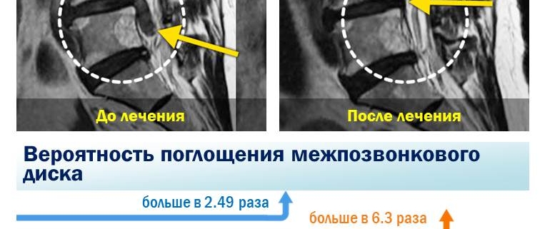 Результаты клинического исследования показали, что после лечения секвестрированная грыжа рассосалась. В Научно-исследовательском Институте Часэн по лечению позвоночника в результате последующего наблюдения за 505 пациентами с заболеванием меж позвонковая грыжа, которые получали комплексное лечение травяными препаратами в среднем в течение 4 лет и 3 месяцев, результат показал чем больше грыжа, и больше секвестрация грыжи, тем лучше она абсорбировалась.Цель: с февраля 2012 года по декабрь 2015 года в главном центре Каннам и филиалах (Кванхвамун, Новон, Мокдонг, Джамсил, Пучхон, Бунданг, Сувон, Ансан, Ильсан, Пхенчон, Кванджу, Тэгу, Тэджон, Сомён, Ульсан) 505 пациентов с диагнозом грыжа поясничного диска получили комплексное лечение травяными препаратами.Метод: после комплексного лечения корейской медицины, включая мануальную терапию — Чуна, степень абсорбции диска измерялась с помощью 3D-анализа МРТ и наблюдалась в среднем в течение 4 лет.Научное учреждение: Объединенный научно-исследовательский институт по лечению позвоночника Часэн.Опубликовано в международном академическом журнале уровня SCI (E) «Evidence-based Complementary and Alternative Medicine Journal (IF 1.93)».Легко подумать, что если диск лопнул, его можно удалить только хирургическим путем. Однако в ходе этого исследования было обнаружено, что даже нехирургическое лечение травяными препаратами может в достаточной степени поглотить вытекший диск. В результате наблюдения за степенью абсорбции диска в течение 4 лет в среднем 45 дней аутогенного лечения у большинства из 505 пациентов у 486 пациентов грыжа рассосалась. Среди них секвестрированная грыжа поглощалась лучше, чем выступающая протрузия. Поглощение диска также было выше в секвестрированной грыже, чем в обычной грыже . Пациенты с более чем 50% абсорбции диска с секвестрированной грыжи (48%) были в 3,7 раза выше, чем с выступающим протрузией (13%).Чем больше грыжа «вытекала», тем больше вероятность, что она будет поглощена. Вероятность поглощения лопнувшего диска в 2,49 раза выше, чем у не лопнувшего диска, а у лопнувшей и вытекшей грыжей в 6,3 раза выше вероятность поглощения, чем у простой грыжи.