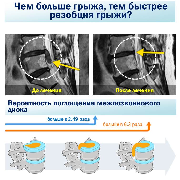 Результаты клинического исследования показали, что после лечения секвестрированная грыжа рассосалась. В Научно-исследовательском Институте Часэн по лечению позвоночника в результате последующего наблюдения за 505 пациентами с заболеванием меж позвонковая грыжа, которые получали комплексное лечение травяными препаратами в среднем в течение 4 лет и 3 месяцев, результат показал чем больше грыжа, и больше секвестрация грыжи, тем лучше она абсорбировалась.Цель: с февраля 2012 года по декабрь 2015 года в главном центре Каннам и филиалах (Кванхвамун, Новон, Мокдонг, Джамсил, Пучхон, Бунданг, Сувон, Ансан, Ильсан, Пхенчон, Кванджу, Тэгу, Тэджон, Сомён, Ульсан) 505 пациентов с диагнозом грыжа поясничного диска получили комплексное лечение травяными препаратами.Метод: после комплексного лечения корейской медицины, включая мануальную терапию — Чуна, степень абсорбции диска измерялась с помощью 3D-анализа МРТ и наблюдалась в среднем в течение 4 лет.Научное учреждение: Объединенный научно-исследовательский институт по лечению позвоночника Часэн.Опубликовано в международном академическом журнале уровня SCI (E) «Evidence-based Complementary and Alternative Medicine Journal (IF 1.93)».Легко подумать, что если диск лопнул, его можно удалить только хирургическим путем. Однако в ходе этого исследования было обнаружено, что даже нехирургическое лечение травяными препаратами может в достаточной степени поглотить вытекший диск. В результате наблюдения за степенью абсорбции диска в течение 4 лет в среднем 45 дней аутогенного лечения у большинства из 505 пациентов у 486 пациентов грыжа рассосалась. Среди них секвестрированная грыжа поглощалась лучше, чем выступающая протрузия. Поглощение диска также было выше в секвестрированной грыже, чем в обычной грыже . Пациенты с более чем 50% абсорбции диска с секвестрированной грыжи (48%) были в 3,7 раза выше, чем с выступающим протрузией (13%).Чем больше грыжа «вытекала», тем больше вероятность, что она будет поглощена. Вероятность поглощения лопнувшего диска в 2,49 раза выше, чем у не лопнувшего диска, а у лопнувшей и вытекшей грыжей в 6,3 раза выше вероятность поглощения, чем у простой грыжи.
