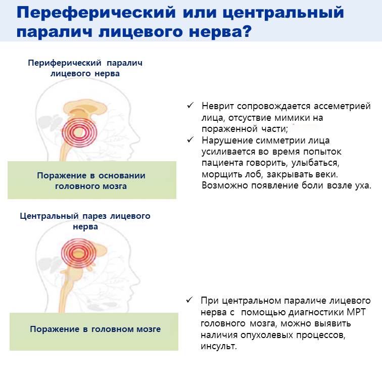 Первое различие заключается в том, является ли паралич лицевого нерва заболеванием центральной нервной системы и головного мозга или представляет собой паралич лицевого нерва, как следствие повреждения периферической нервной системы! Если это связано с патологиями головного мозга, тогда методы лечения будут отличаться и точную причину можно будет подтвердить с помощью обследований КТ или МРТ. В случае периферического паралича лицевого нерва большинство причин вызваны вирусной инфекцией, из-за снижения иммунитета. Поэтому в ранней острой фазе (7-10 дней) в западной медицине применяют стериодные препараты, чтобы уменьшить воспаление и отек нервов, тем самым уменьшая повреждение нервов. А также эффективным может оказаться совместный прием противовирусного препарата в течение 3 дней. Лечение периферического паралича лицевого нерва может быть еще более эффективным, если в этот момент в комплексе получать акупунктуру, для смягчения затвердевших мышц, терапию «Чуна» на область лица, травяные лекарственные препараты и др.