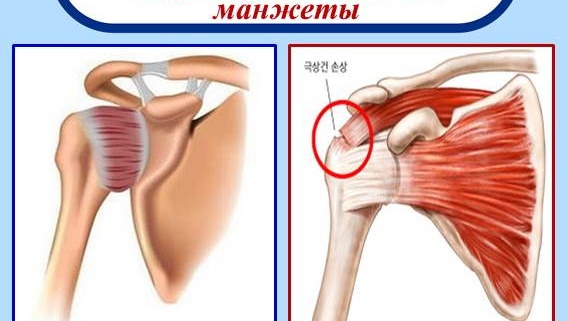 Когда болит плечо, чаще всего люди подозревают, что у них начался синдром замороженного плеча. Но при одинаковых симптомах боли, в суставе могут быть совсем разные заболевания. Чаще всего другие заболевания можно спутать с разрывом мягких тканей плечевого сустава. Разумеется сразу возникает вопрос: «Как можно легким способом определить у меня синдром замороженного плеча или же разрыв мягких тканей в плече?»