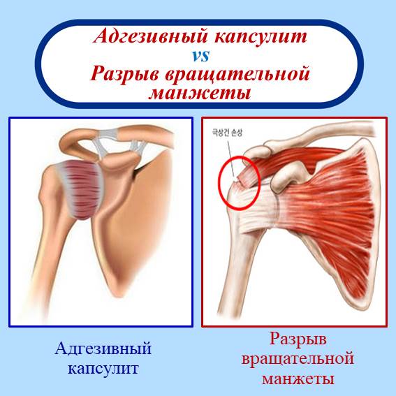 Когда болит плечо, чаще всего люди подозревают, что у них начался синдром замороженного плеча. Но при одинаковых симптомах боли, в суставе могут быть совсем разные заболевания. Чаще всего другие заболевания можно спутать с разрывом мягких тканей плечевого сустава. Разумеется сразу возникает вопрос: «Как можно легким способом определить у меня синдром замороженного плеча или же разрыв мягких тканей в плече?»