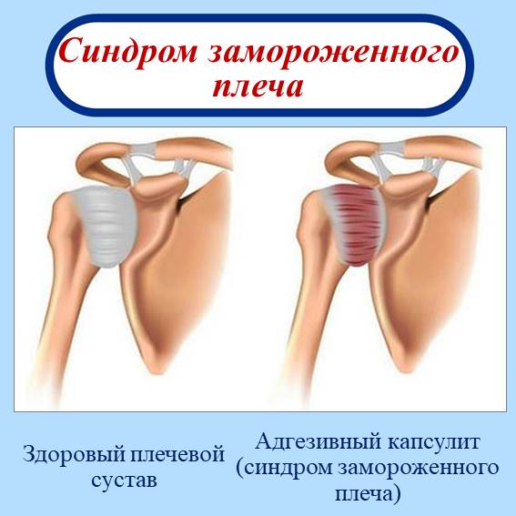 Адгезивный капсулит (синдром замороженного плеча) Официальное медицинское название заболевания синдрома замороженного плеча – адгезивный капсулит. Дегенеративные изменения вызывают воспаления в суставной оболочке, окружающей плечевой сустав, что в свою очередь провоцируют боли, из-за чего движения плечевого сустава становятся ограниченными, в связи с чем заболевание приобрело название «замороженное плечо».
