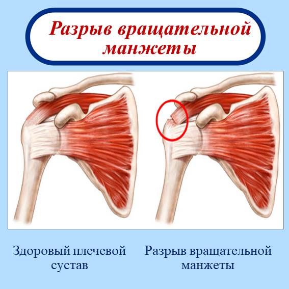 сустава входят лопатка, плечевая кость и другие части. Все они связаны между собой мышцами, связками и сухожилиями, такую конструкцию называют вращательной манжетой. Повреждения и/или разрывы в мышцах, связках и сухожилиях плечевого сустава подразумевают собой разрыв вращательной манжеты. Оба заболевания вызывают боли в плечевом суставе, однако их месторасположение отличается друг от друга: - если проблемы появились в плечевом суставе, тогда это относится к – адгезивному капсулиту (синдрому замороженного плеча); - если проблемы появились в мягких тканях плечевого сустава, в таком случае следует подозревать разрыв вращательной манжеты. В обоих случаях пациенту трудно самостоятельно поднять руку вверх. Однако, когда руку пациента в спокойном состоянии поднимает другой человек, заметны отличия между симптомами заболеваний: -при адгезивном капсулите, боль появляется когда угол поднятия руки превышает определенный уровень; - наоборот, при разрыве вращательной манжеты, можете естественно поднять руки к голове, без боли. Также отличия этих заболеваний можно заметить между женским и мужским полом и в возрастных группах: - адгезивным капсулитом чаще болеют пациенты женского пола, - разрыв вращательной манжеты чаще всего встречается среди мужчин и у людей, кто много занимается спортом. Поскольку боли сильные как при адгезивном капсулите, так и при разрыве вращательной манжеты, прежде всего лечение необходимо проводить с целью устранения отеков и воспаления. Какими методами проводят лечение без операции в центре Часэн?