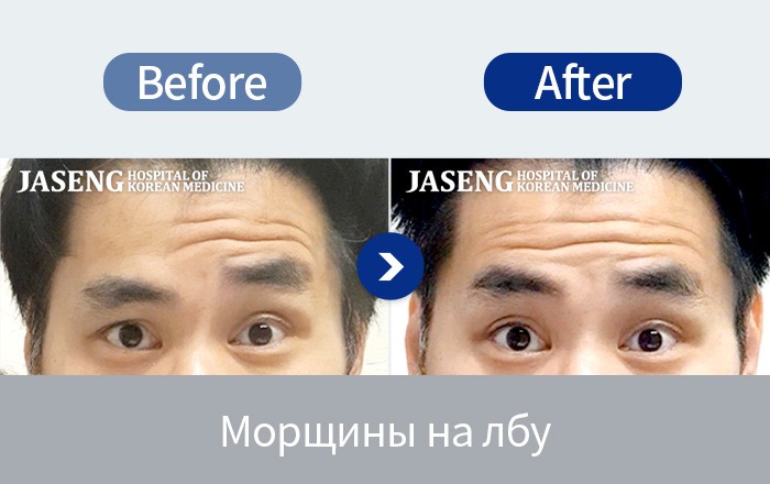 Лицевой паралич