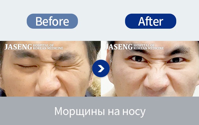 Лицевой паралич