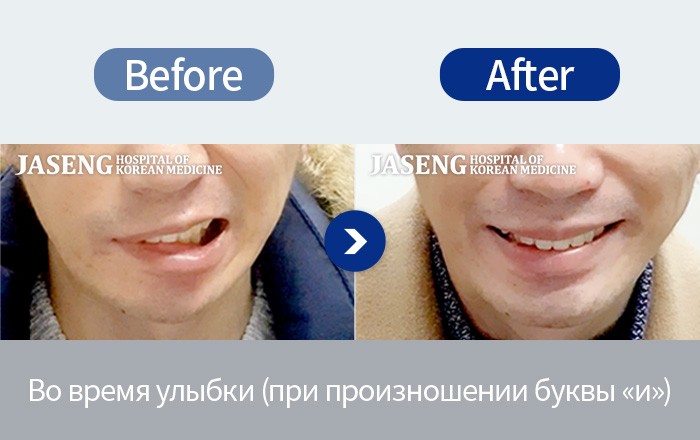 Лицевой паралич