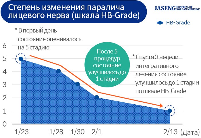 Лицевой паралич
