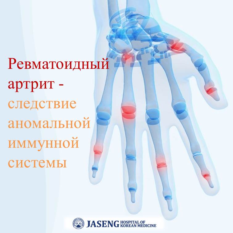 Ревматоидный артрит - представитель аутоиммунного заболевания. Иммунная система, которая защищает наш организм от бактерий и посторонних веществ, по неизвестным причинам распознает сустав как фактор атаки и вызывает стойкое воспаление в мембранах, окружающие сустав. Воспаление усиливается и застывшая воспалительная масса деформирует и повреждает хрящи, суставы и костную ткань. В итоге заболевание приводит к искривлению и отеку костей в области поражения артритом, а в тяжелых случаях может быть вызван костный анкилоз, который приводит к полному затвердеванию суставов.
