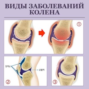 Не смотря на то, что симптомы могут быть одинаковые, разновидностей заболеваний коленных суставов очень много и все они отличаются между собой. Чтобы определить какое именно у вас заболевание и во время начать соответствующее лечение, необходимо пройти личную консультацию со специалистом, точную диагностику и установить диагноз.
