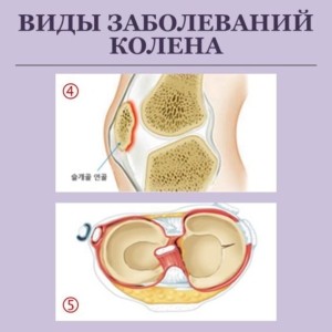 Повреждение связки надколенника, Коленный бурсит