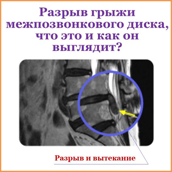 Разрыв грыжи межпозвонкового диска означает вытекание пульпозного ядра, расположенного внутри фиброзного кольца межпозвонкового диска, который выпячивает наружу из-за неправильной осанки, дегенеративных изменений, физического шока, такого как дорожно-транспортное происшествие и ряда других причин. Когда межпозвонковый диск выпячивает наружу, он давит на нервные корешки, из-за чего появляются такие симптомы, как боль в спине и в нижних конечностях, онемение, мышечная слабость и др.