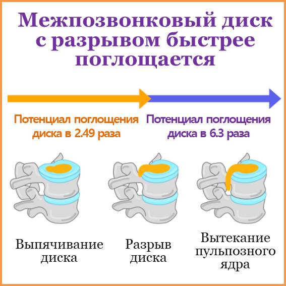 Межпозвонковый диск с разрывом быстрее поглощается То, что диск разорвался, не означает, что вам непременно требуется операция. Наоборот, существует много научных исследований, которые доказывают, что чем тяжелее степень разрыва диска, тем больше вероятность его поглощения. Гипотеза полгощения выступающего межпозвонкового диска с разрывом Хотя механизм поглощения еще точно не ясен, доминирующая гипотеза состоит в том, что диск тесно связан с иммунной системой: Формирование кровеносных сосудов внутри диска с разрывом Производство иммунных веществ, таких как макрофаги Полгощение межпозвонковой грыжи Активная деятельность, такая как фагоцитоз макрофагов и секреция протеолитических ферментов Согласно гипотезе, в конце концов, наш организм способен самостоятельно исцелить себя без хирургического вмешательства.